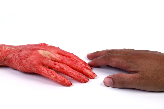  Una persona hospitalizada con quemaduras graves tras incendio de dos alarmas